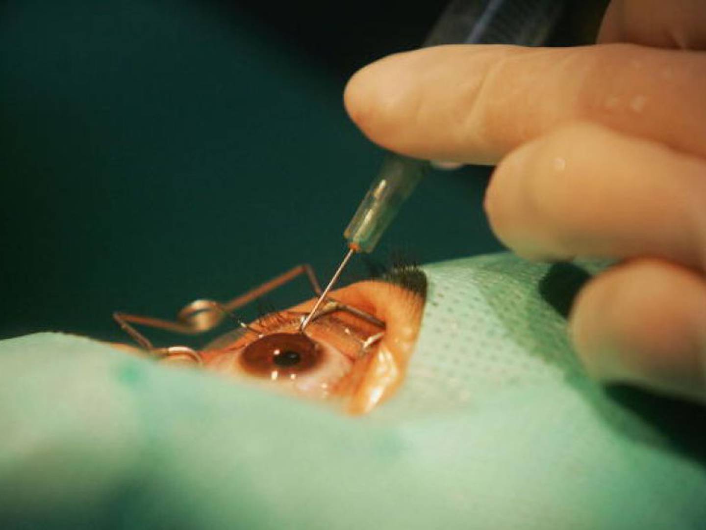 Así se extraen 23 lentes de contacto del ojo de una paciente
